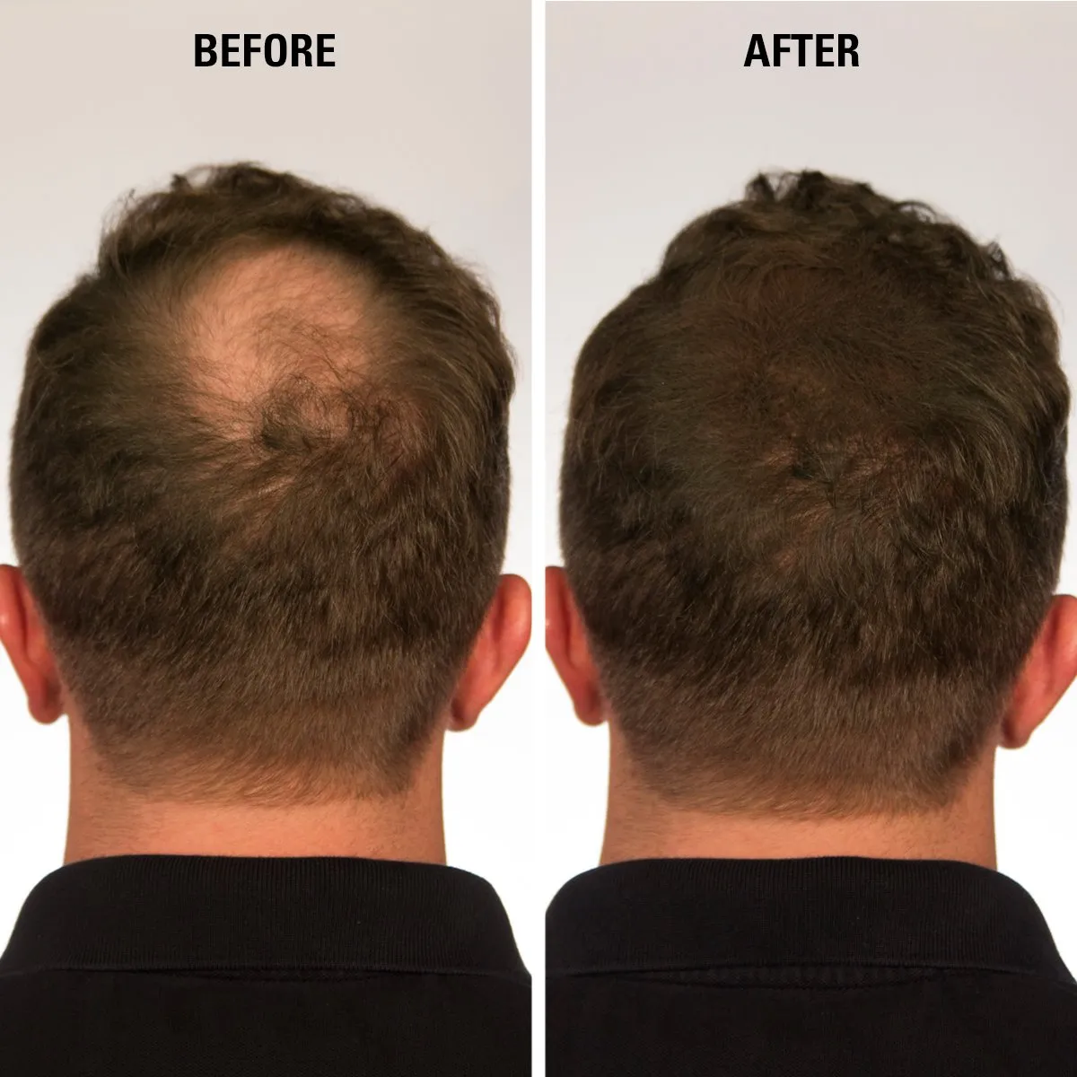 Hair Fiber Medium Brown, Hair Thickening Fiber - Hair Loss Concealer for Men & Women, 28g